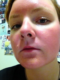 Blisters on my chin and nose....